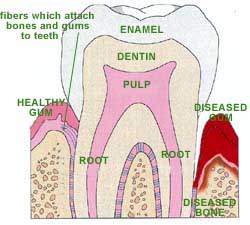 Gum Surgery