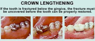 Crown Lengthening