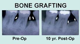 Bone Grafts