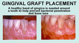 Gingival Graft Replacement