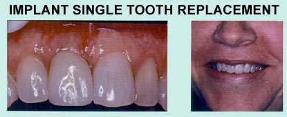 Implant Single Tooth Replacement
